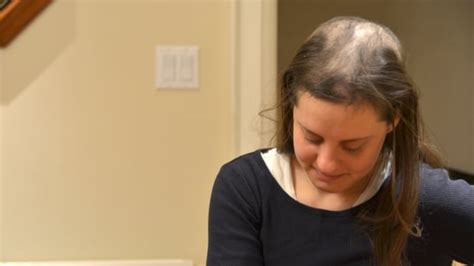 the truth about trichotillomania the hair pulling disorder cbc life