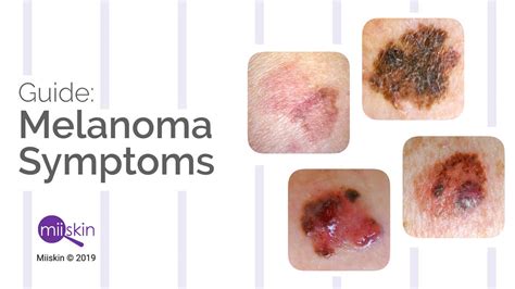 Early Stage Melanoma Skin Cancer Signs