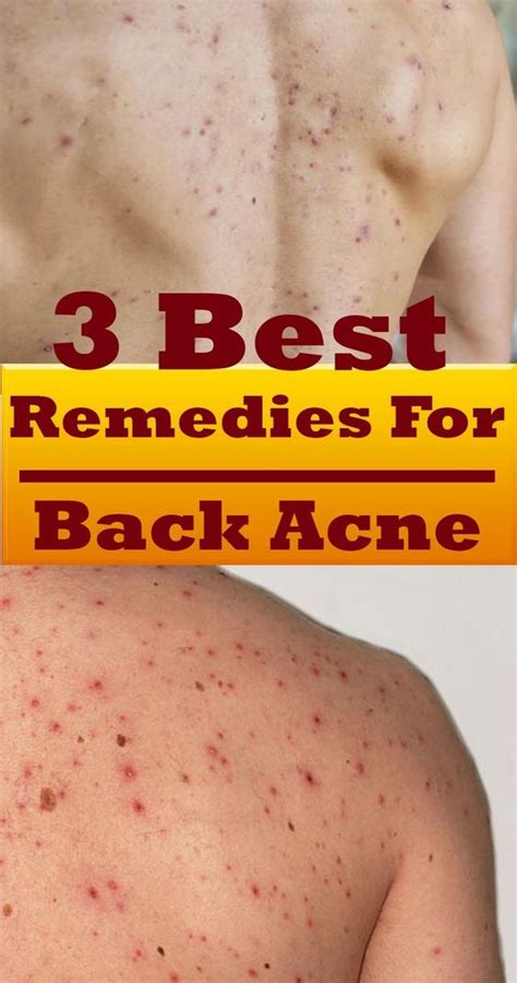 3 Best Remedies For Back Acne Sweet Oh Joy