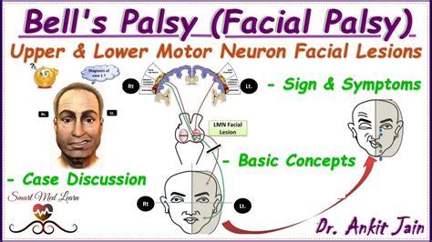 Bells Palsy Upper And Lower Motor Neuron Facial Palsy Central Facial