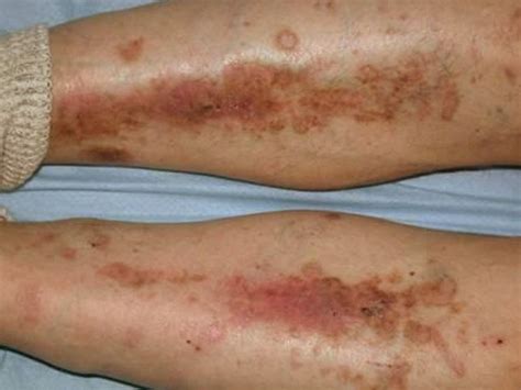 Diabetic Dry Skin On Legs Pictures 1 Symptoms And Pictures