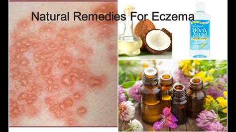 Effective Natural Home Remedies For Eczema Youtube