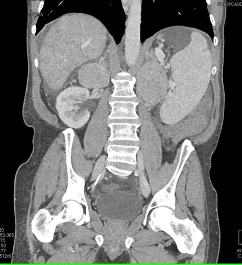 Hepatoma And Bilateral Adrenal Metastases Adrenal Case Studies