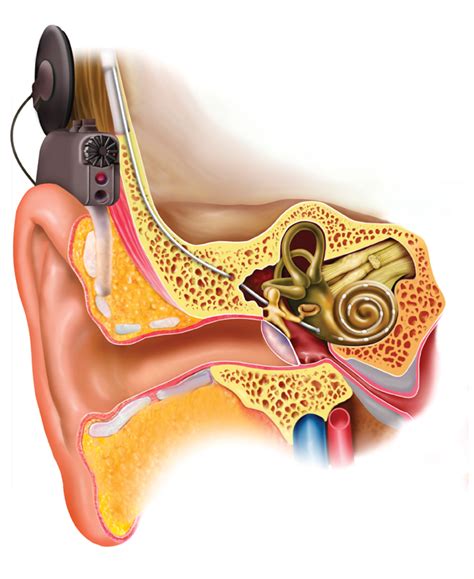 Internal Parts Of A Cochlear Implant Advanced Bionics My Xxx Hot Girl