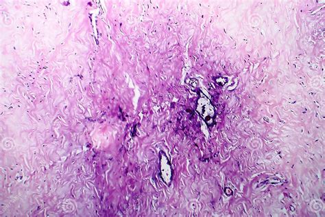 Breast Fibroadenosis Light Micrograph Stock Photo Image Of