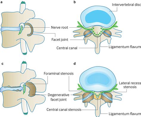 Lumbar Spinal Stenosis Oxford Spine And Neuro