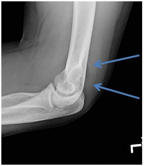 Elbow Pain And Swelling After A Fall Page 2 Of 2 Journal Of Urgent