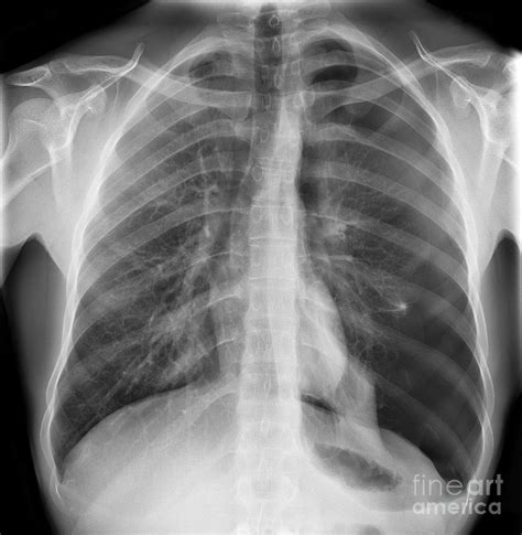 Pneumothorax X Ray Photograph By Science Photo Library