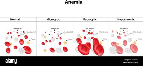Types Of Anemia Stock Vector Art And Illustration Vector Image 78697012