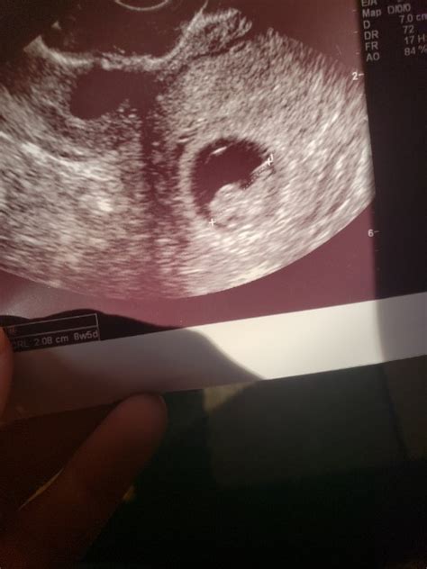 Had My First Ultrasound Today Measuring 8 Weeks 5 Days After 4