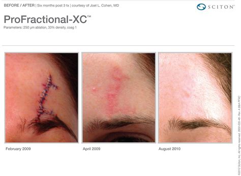 New Sciton® Laser Scar Revision Treatment Aya Skin Care