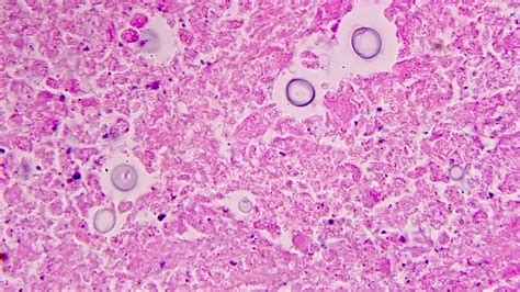 Pathology Outlines Cryptococcus Neoformans And Gatti