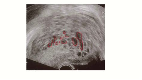 Hydatidiform Mole Molar Pregnancy Complete And Partial Mole L Gtd L