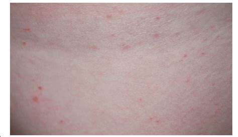 Papules And Erythema On The Leg Of The Infested Child Download
