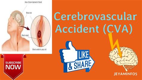 Cerebrovascular Accidentcvastroke Cerebral Infarctionbrain Attackcerebrovascular