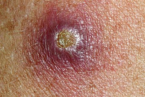 Cutaneous Leishmaniasis Photograph By Dr Morley Read Science Photo Library Pixels Merch
