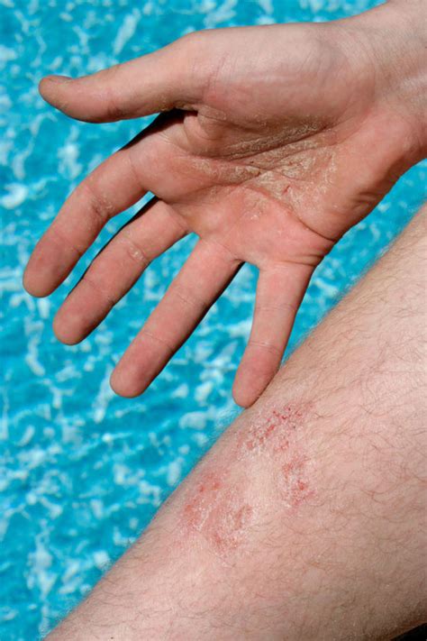 Psoriasis Patient On How The Condition Has Became A Full