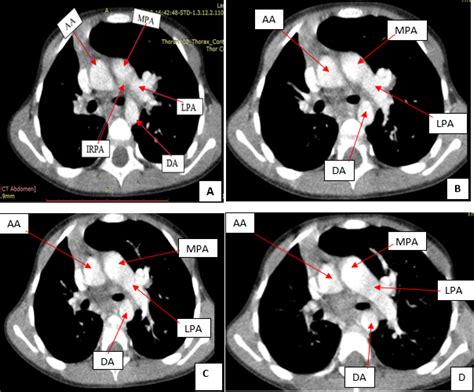 Full Text Isolated Absence Of Right Pulmonary Artery In
