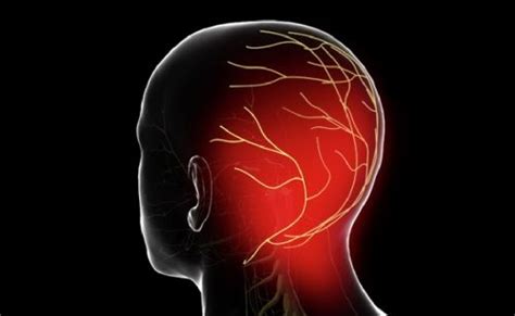 Case Study Occipital Neuralgia Artofit