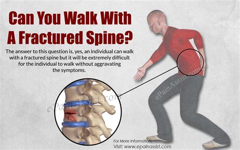 Can You Walk With A Fractured Spine