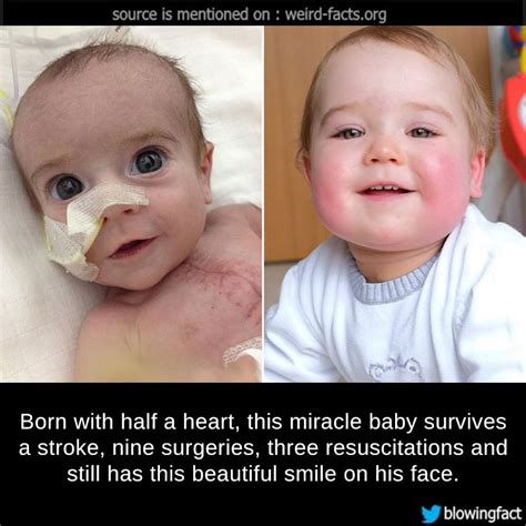 Weird Facts — Born With Half A Heart This Miracle Baby Survives