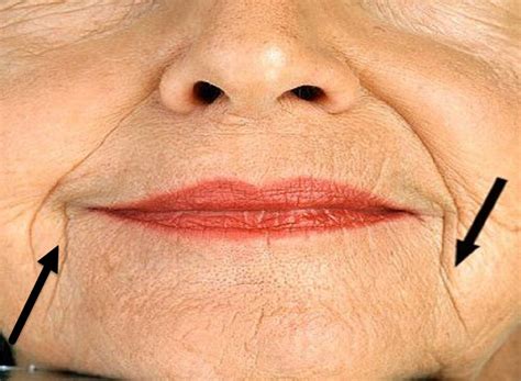Marionette Chin Wrinkle Lines Bristol Dr Brads Laser And Cosmetic