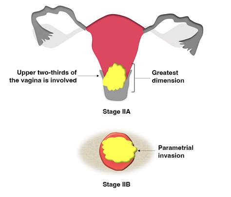 Staging Of Cervical Cancer A Practical Approach Using Mri And Fdg Pet
