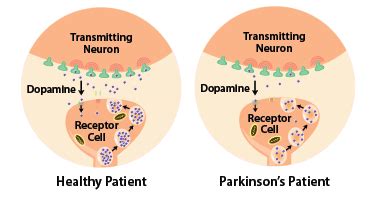 The medical treatment of parkinson disease from james parkinson to george cotzias. Parkinson's Disease - The School of Biomedical Sciences Wiki