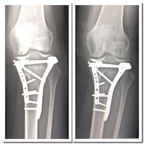 Tibia Fracture Ankle Tibial Plateau Fracture Recovery Vrogue Co