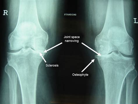 Osteoarthritis Science Of Aging Knowledge Environment