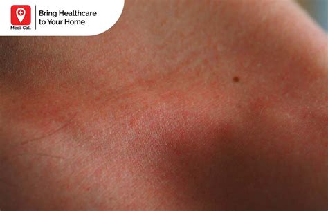 Cara Mengatasi Bentol Akibat Alergi Dingin di Rumah