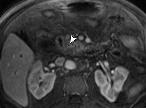 Benign Biliary Strictures A Current Comprehensive Clinical And Imaging