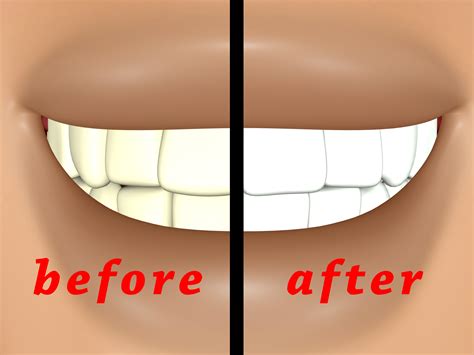 6 Ways to Get Whiter Teeth at Home - wikiHow