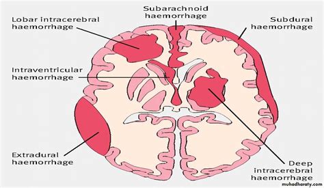 Intracranial Hemorrhage Coggle Diagram Gambaran