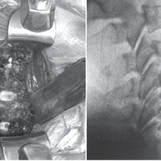 X-rays showing lumbosacral transitional vertebrae ...
