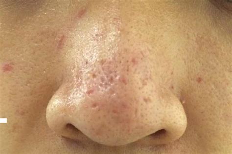 Deep Nose Scars On Left Side On Upper Nose Nostrils With Pics Scar