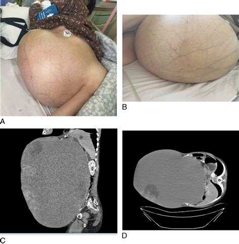Postmenopausal Giant Ovarian Tumor A Rare Case Report And L Menopause