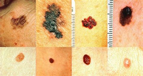 How To Recognize Skin Cancer This Could Save Your Life Make Your Life Healthier