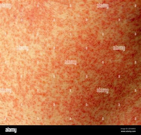 Allergic Reaction Hi Res Stock Photography And Images Alamy