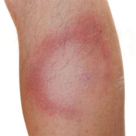 Not All Round Rashes Are Ringworm A Differential Relias Media