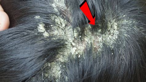 Dandruff Scratching Itchy Dry Scalp Huge Flake Psoriasis Treatment