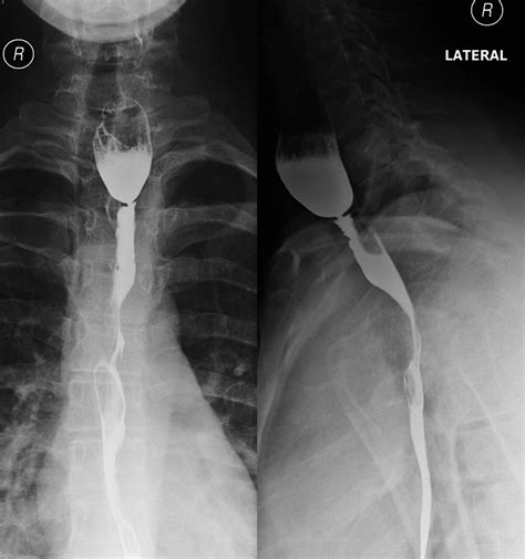 Dysphagia is the first and most prominent symptom. Plummer-Vinson syndrome/esophageal web. Causes, symptoms ...