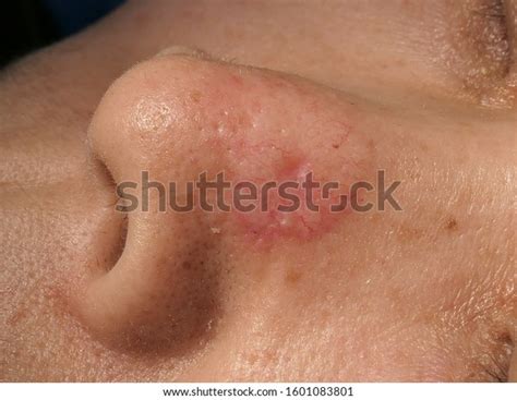 Skin Cancer Basal Cell Carcinoma On Stock Photo Edit Now 1601083801