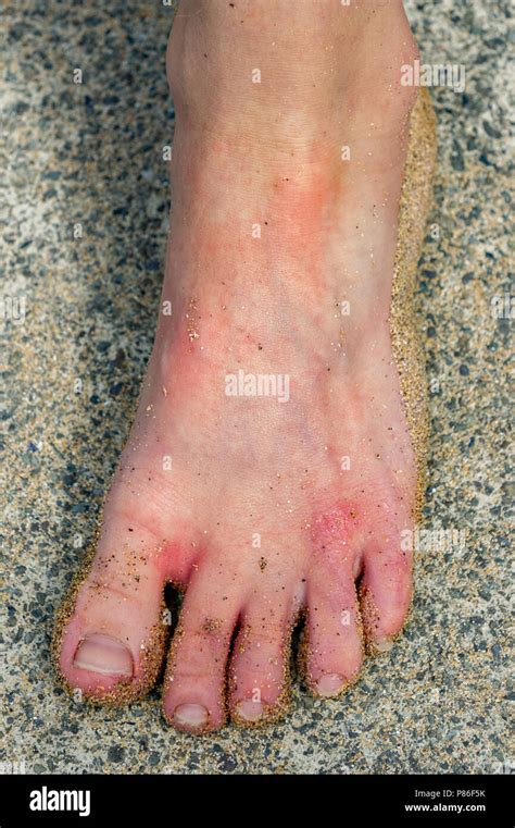 Young Boy Stung By Jellyfish Hi Res Stock Photography And Images Alamy