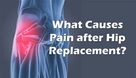 Pain After Hip Replacement Is It Your Tendons Regenexx