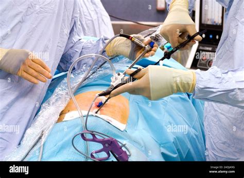 Model Released Hernia Operation Surgeons Performing Laparoscopic