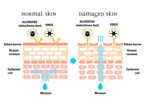 Why Do You Have A Skin Barrier Damaged Skin Skin Cosmetic Medicine