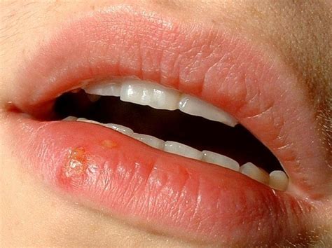 Сифилис во рту на языке десне и слизистой проявления болезни в ротвой полости