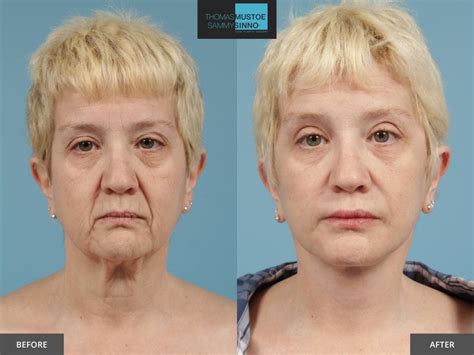 Facelift Before And After Photos Prove Just How Natural Todays Results Look Tlkm Plastic Surgery