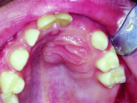 Clinical Features Of The Patient With A Maxillary Dentigerous Cyst
